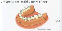 すべての歯を失った場合：ブリッジ・部分入れ歯・総入れ歯