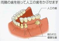 隣接する歯を1、2本失った場合：ブリッジ・部分入れ歯・総入れ歯